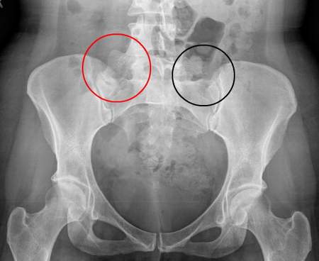 Viêm khớp cùng chậu - Hình ảnh minh họa